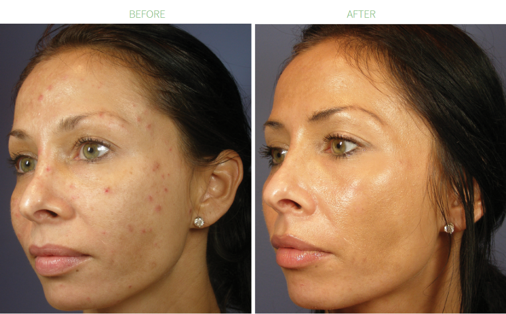 The Benefits of a Chemical Peel Facial