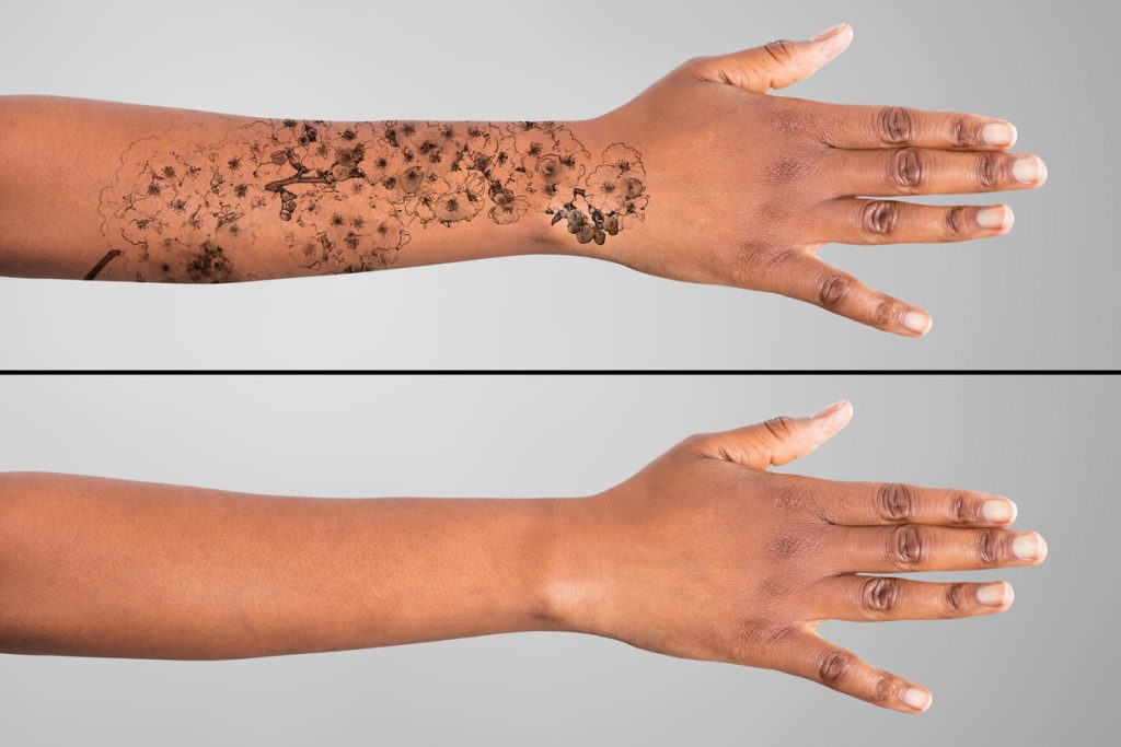 Laser Tattoo Removal On Woman's Hand